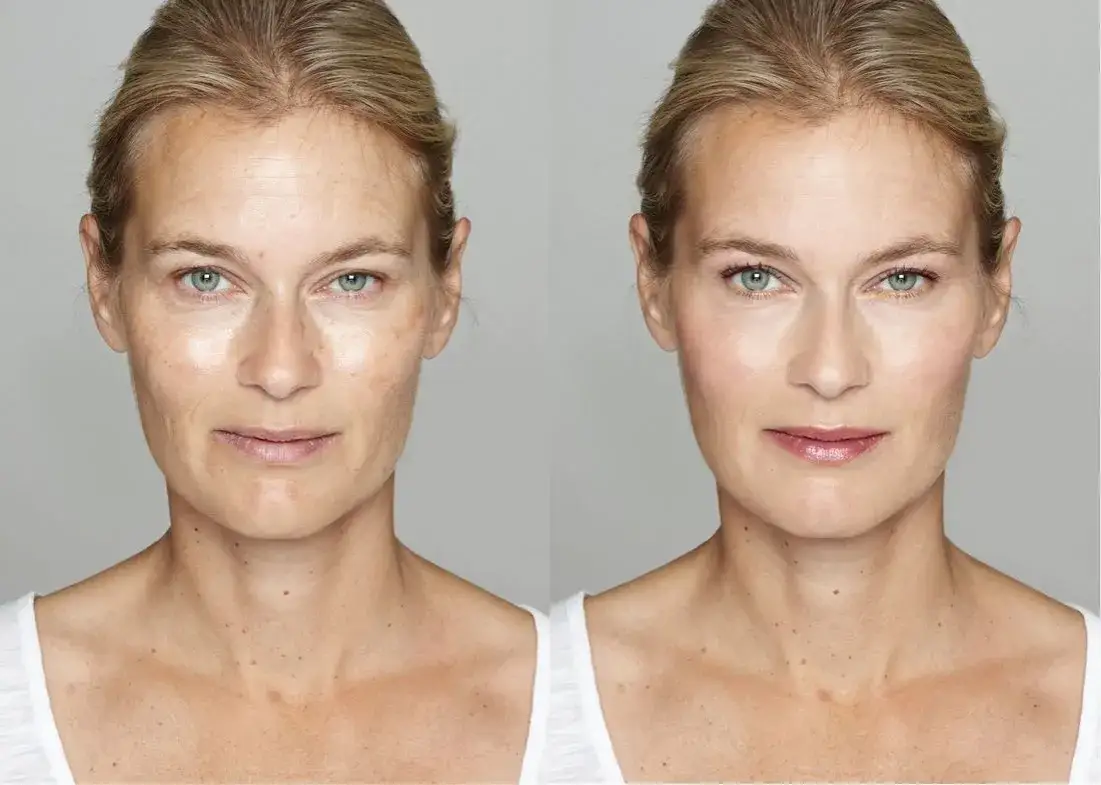 styl życia a botox efekty