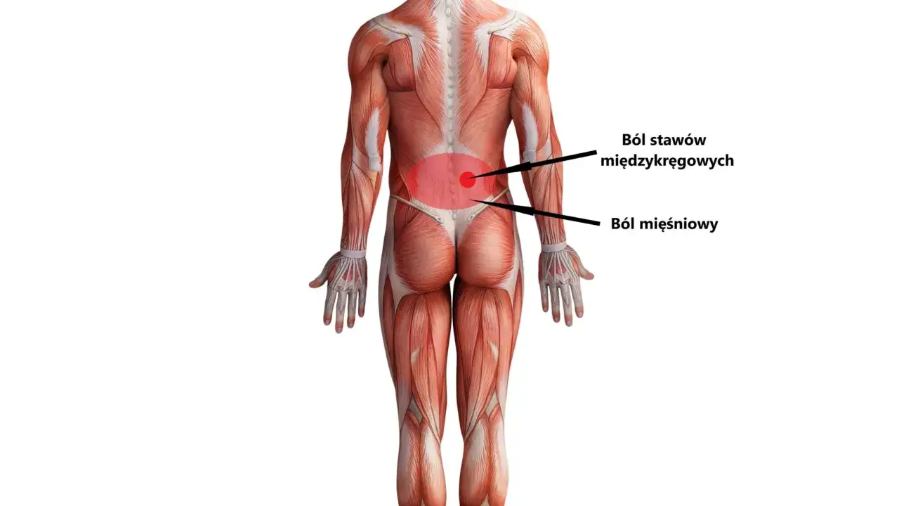 Anatomia pleców z zaznaczonym bólem mięśniowym i stawów międzykręgowych. Może to być objaw hiperlordozy.