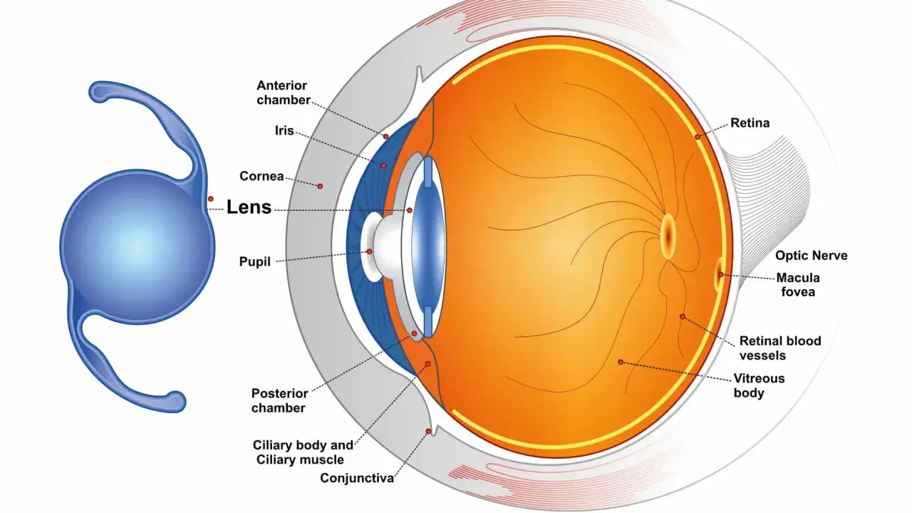 Sezione anatomica dell'occhio con lente intraoculare. Illustra la pseudofachia oculare, mostrando cornea, iride, pupilla, retina e nervo ottico.