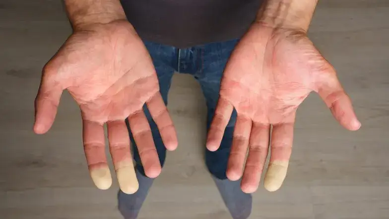 objaw Raynauda dłonie
