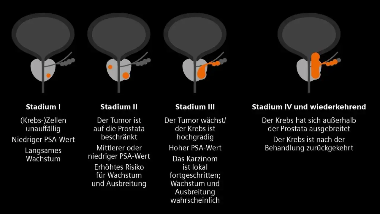 Illustrationen zeigen Stadien von Prostatakrebs. Stadium I hat einen niedrigen PSA-Wert, was auf einen normalen PSA-Wert hindeutet.