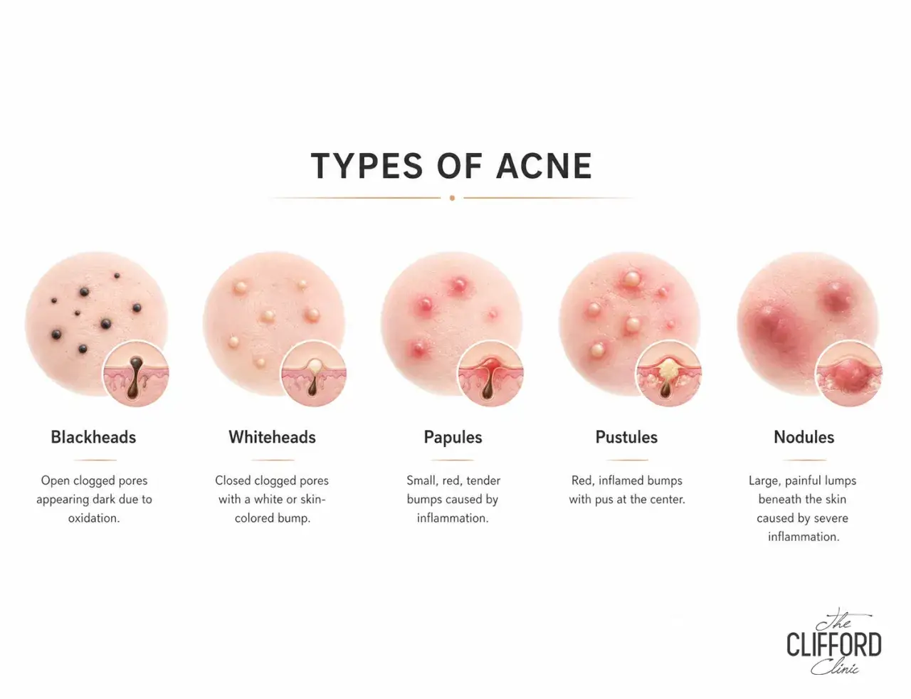 Illustrations montrant les différents types d'acné : points noirs, points blancs, papules, pustules et nodules, des manifestations courantes du bouton de puberté.