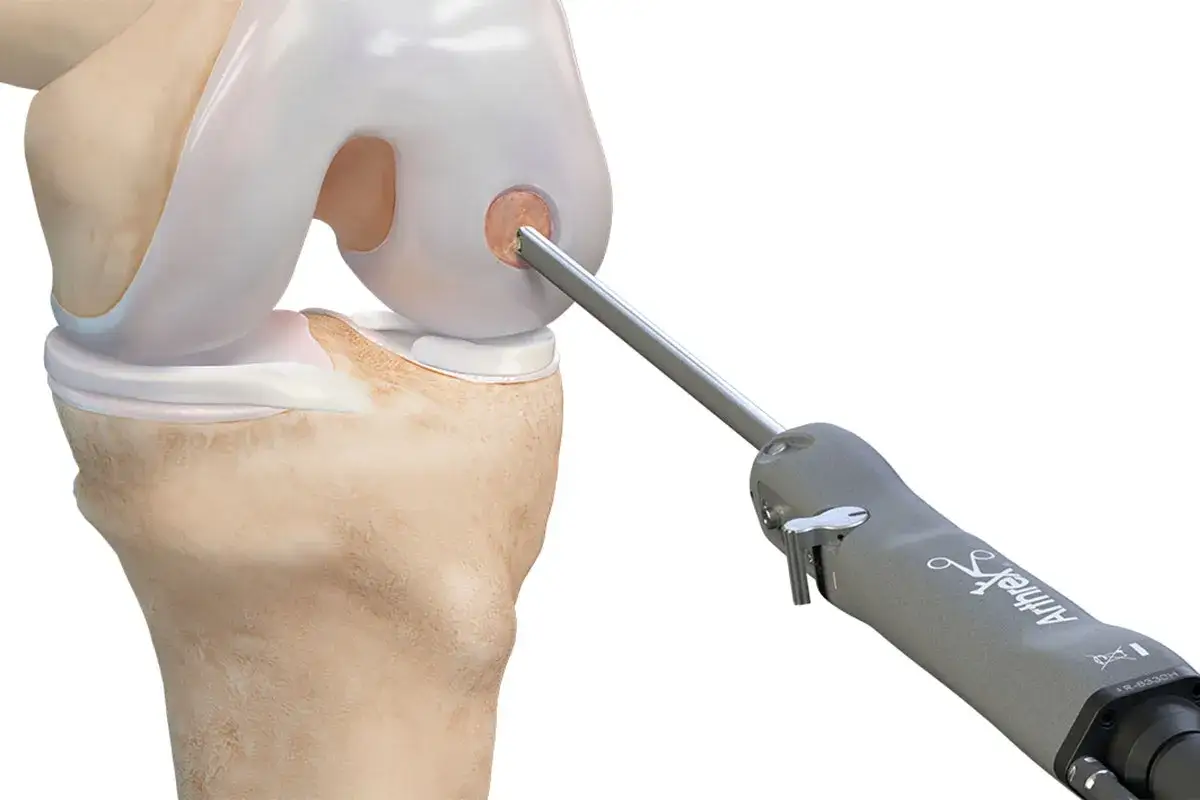 Chondropathie Grad 4 Therapie: Arthroskopisches Instrument bearbeitet Knorpeldefekt im Kniegelenk.