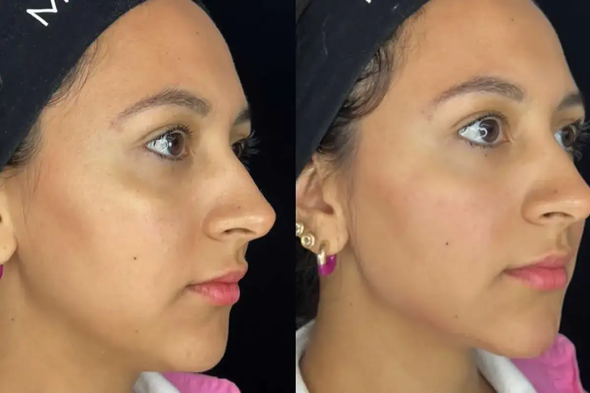 Comparaci&oacute;n antes y despu&eacute;s de un tratamiento facial. El &aacute;cido hialur&oacute;nico para que sirve: mejora la hidrataci&oacute;n y volumen de la piel, logrando un aspecto m&aacute;s rejuvenecido.