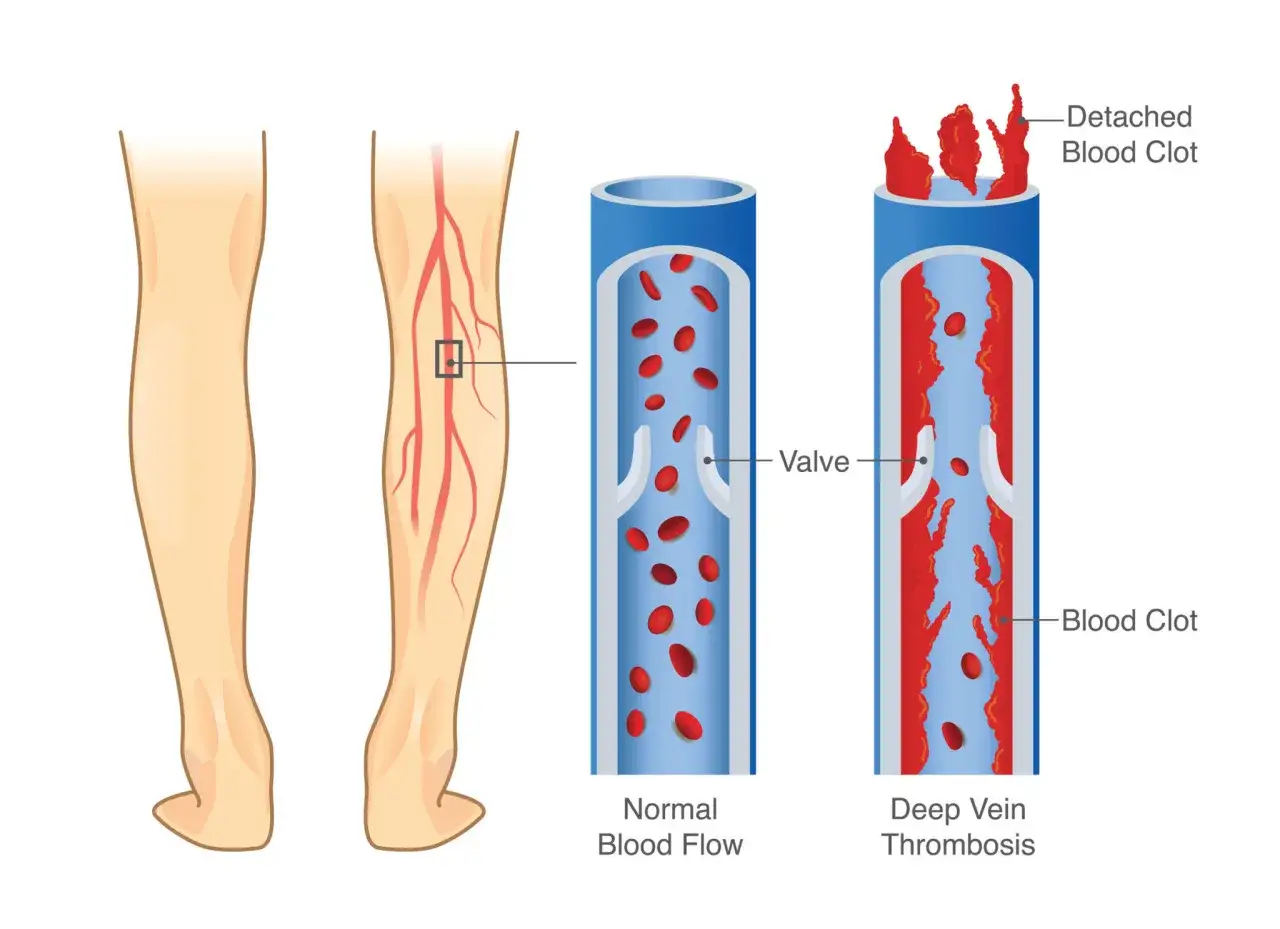 Illustration zeigt, was ist Thrombose: ein Blutgerinnsel in einer Vene, das den Blutfluss behindert. Normaler Blutfluss vs. tiefe Venenthrombose.