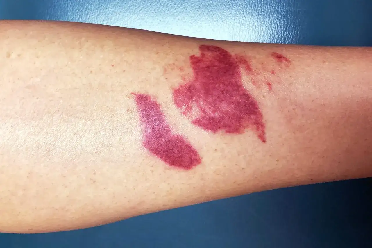 Hautirritationen mit roten Flecken, die an eine allergische Reaktion erinnern. Vorsicht: Aloe Vera kann giftig auf Haut wirken.