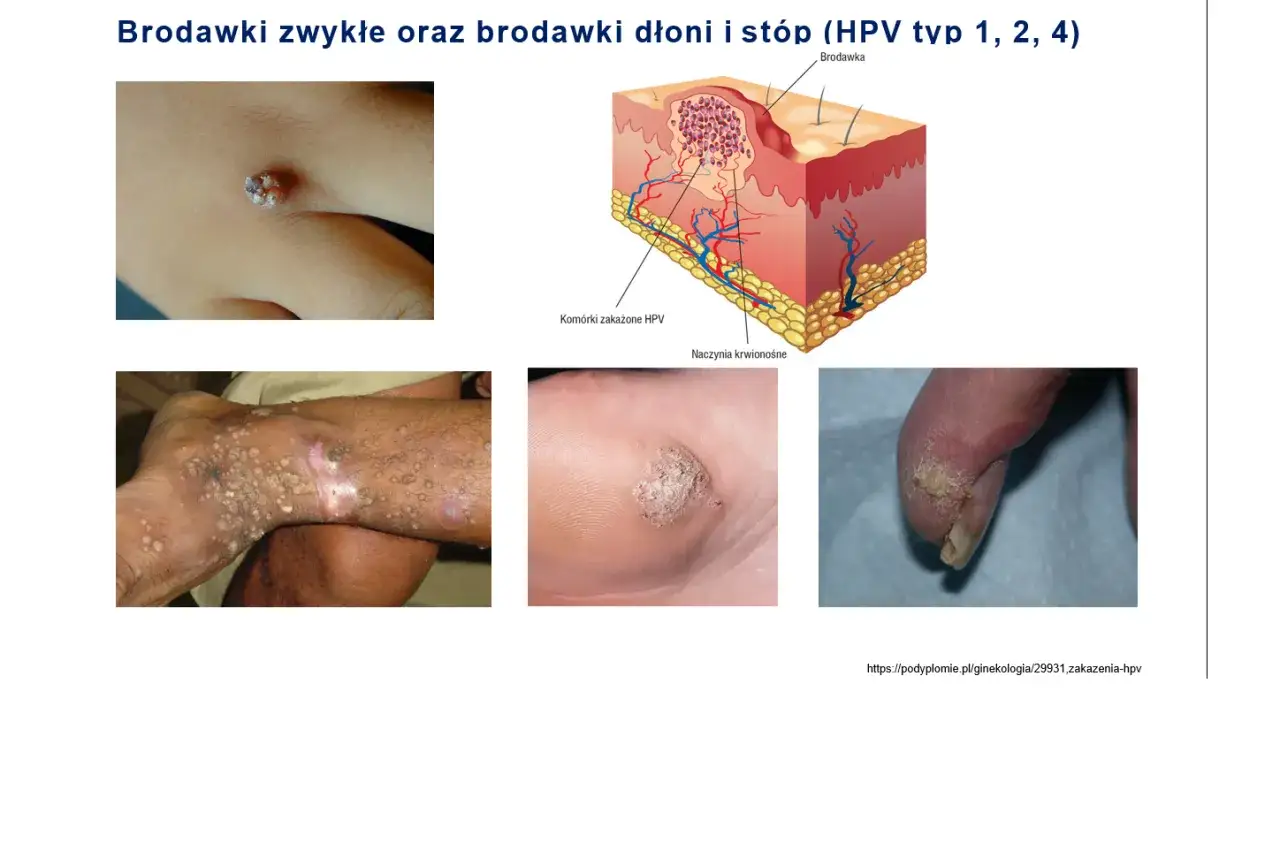 r&oacute;żnica między kurzajką a kłykciną grafika