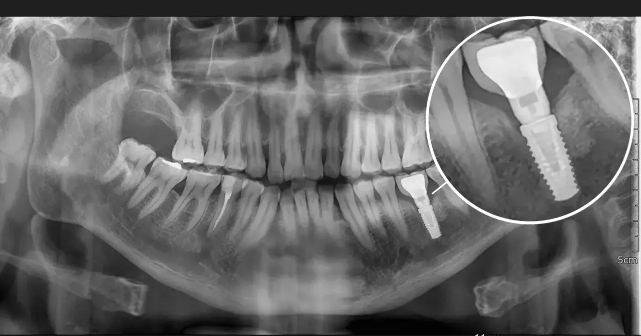 RTG szczęki z widocznym implantem stomatologicznym. Powiększony fragment pokazuje szczegóły augmentacji kości i samego implantu.