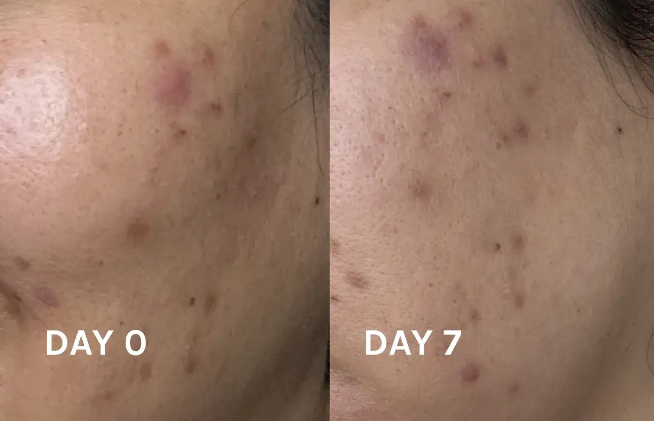 F&ouml;re och efter bilder visar tydliga epiduo resultat p&aring; akne efter 7 dagar.