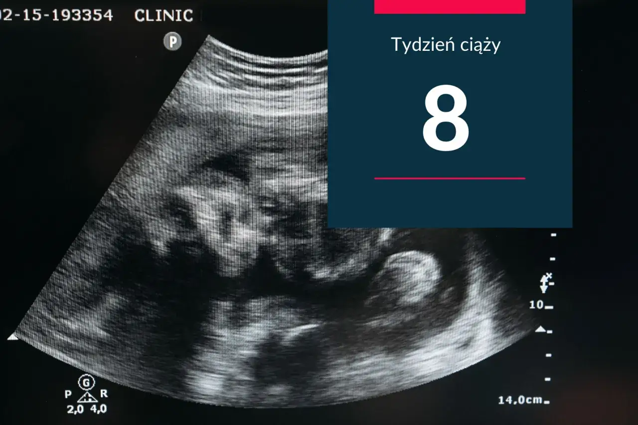 USG 3D pokazuje zarodek w 8 tygodniu ciąży. To wczesny etap rozwoju, pełen nadziei.