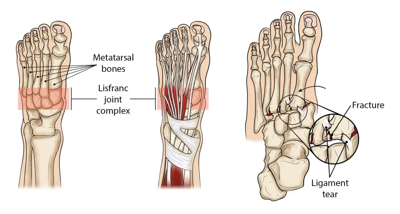 Anatomische Darstellung des Fußes mit Hervorhebung des Lisfranc-Gelenks. Zeigt Frakturen und Bänderrisse im Bereich des Lisfranc-Gelenks.