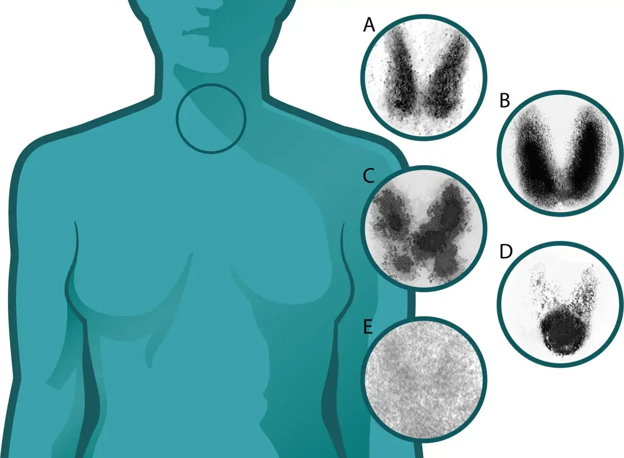 Illustrazione di una figura umana con la tiroide evidenziata. Cinque immagini mostrano diversi risultati di scintigrafia tiroidea, con aree di diversa captazione del tracciante.
