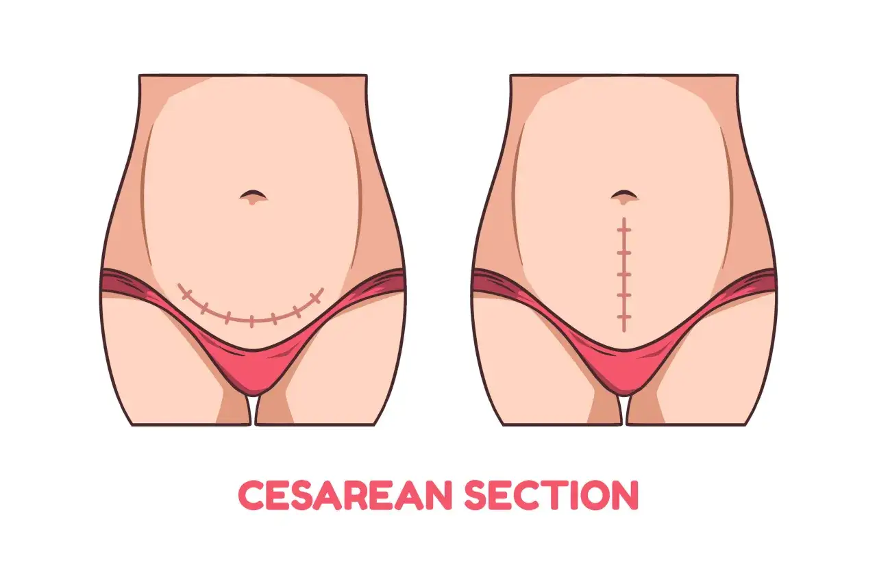 Dwa typy blizn po cesarskim cięciu: pozioma nad linią bikini i pionowa poniżej pępka. Szwy rozpuszczalne po cc są niewidoczne.