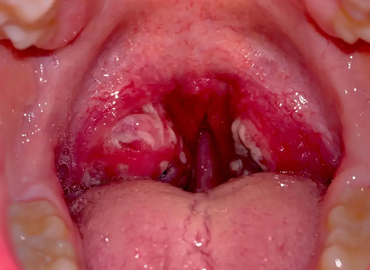 Gola infiammata con placche biancastre, possibile segno di **orticaria da streptococco bambini**.