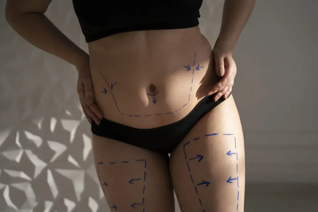 Oznaczenia na brzuchu i udach sugerują planowanie zabiegu liposukcji ultradźwiękowej.