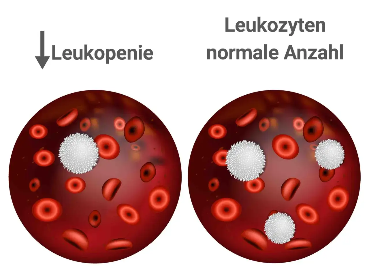 Vergleich von Blutbildern: Links zeigt Leukopenie mit wenigen wei&szlig;en Blutk&ouml;rperchen, rechts normale Anzahl. Leukopenie bedeutet, dass die leukozyten zu niedrig sind.