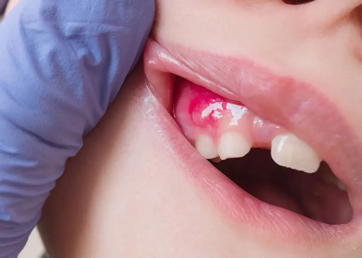 Un dentista examina un agujero en la enc&iacute;a con pus, indicando una posible infecci&oacute;n.
