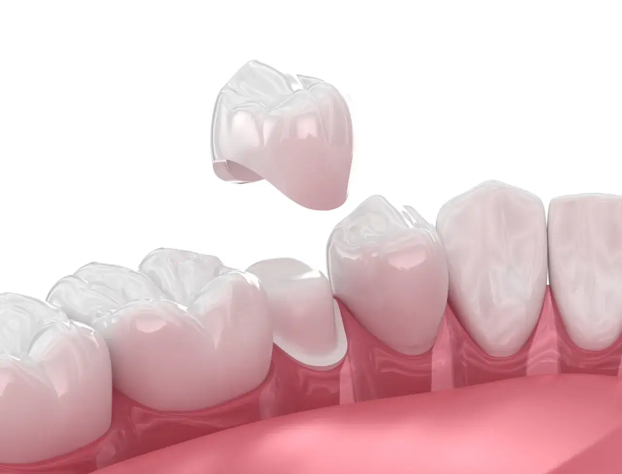 Korona zębowa CAD/CAM CEREC proces