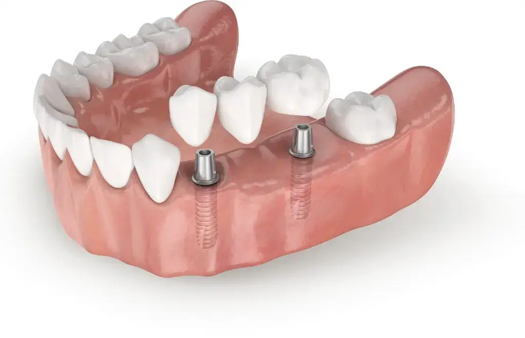 różne metody uzupełniania braków zębowych implant most proteza