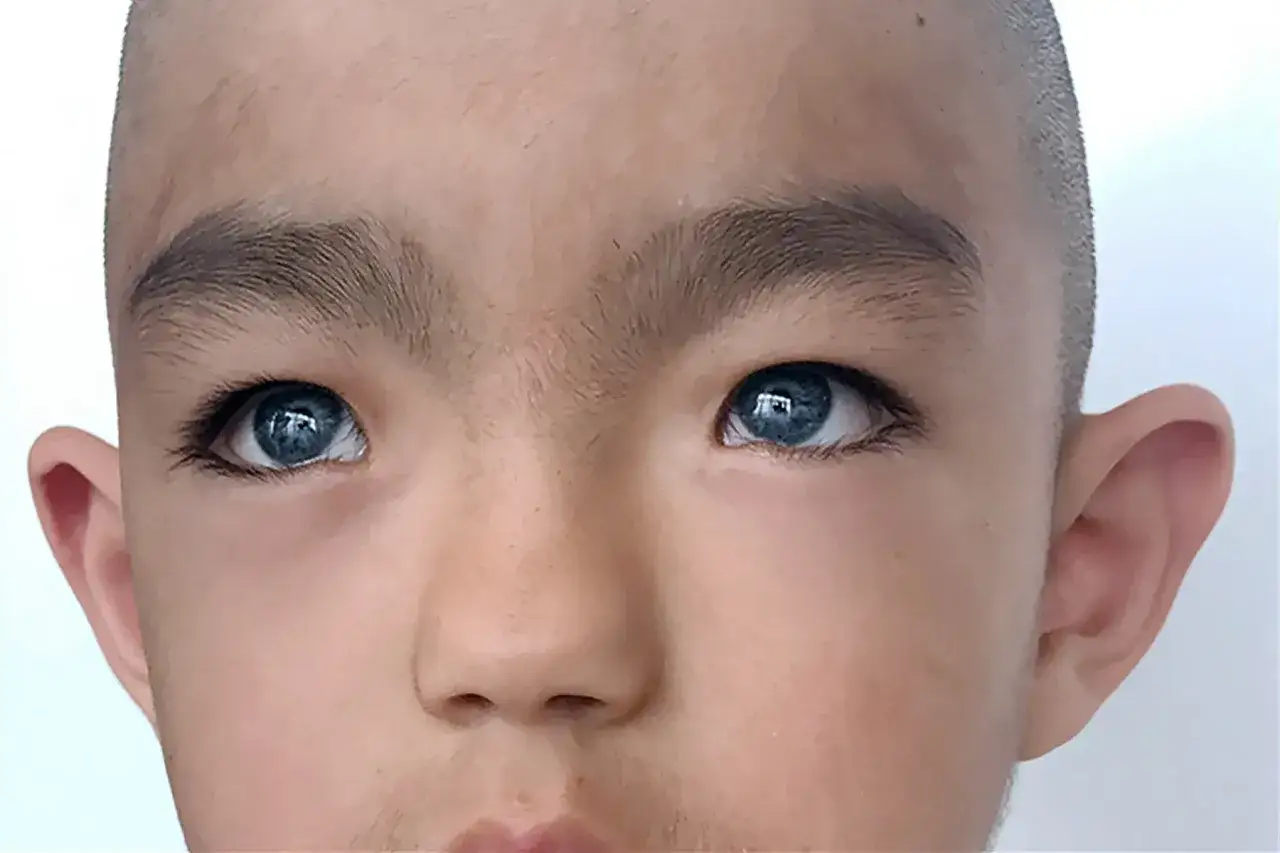 Ojos azules intensos, caracter&iacute;sticos del s&iacute;ndrome de Waardenburg, en un ni&ntilde;o con cabello rapado y orejas prominentes.