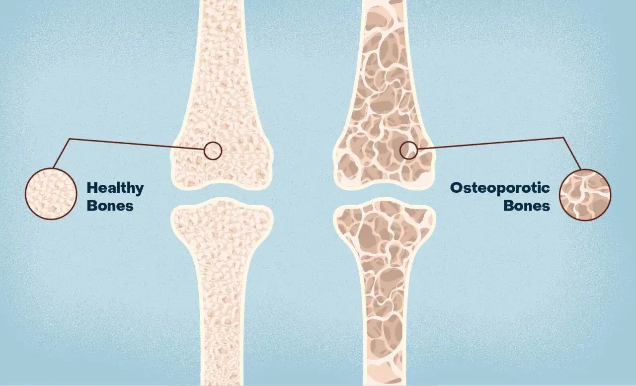 Porównanie zdrowych kości z osteoporotycznymi. Czy osteoporoza to rak kości? Nie, to osłabienie kości.