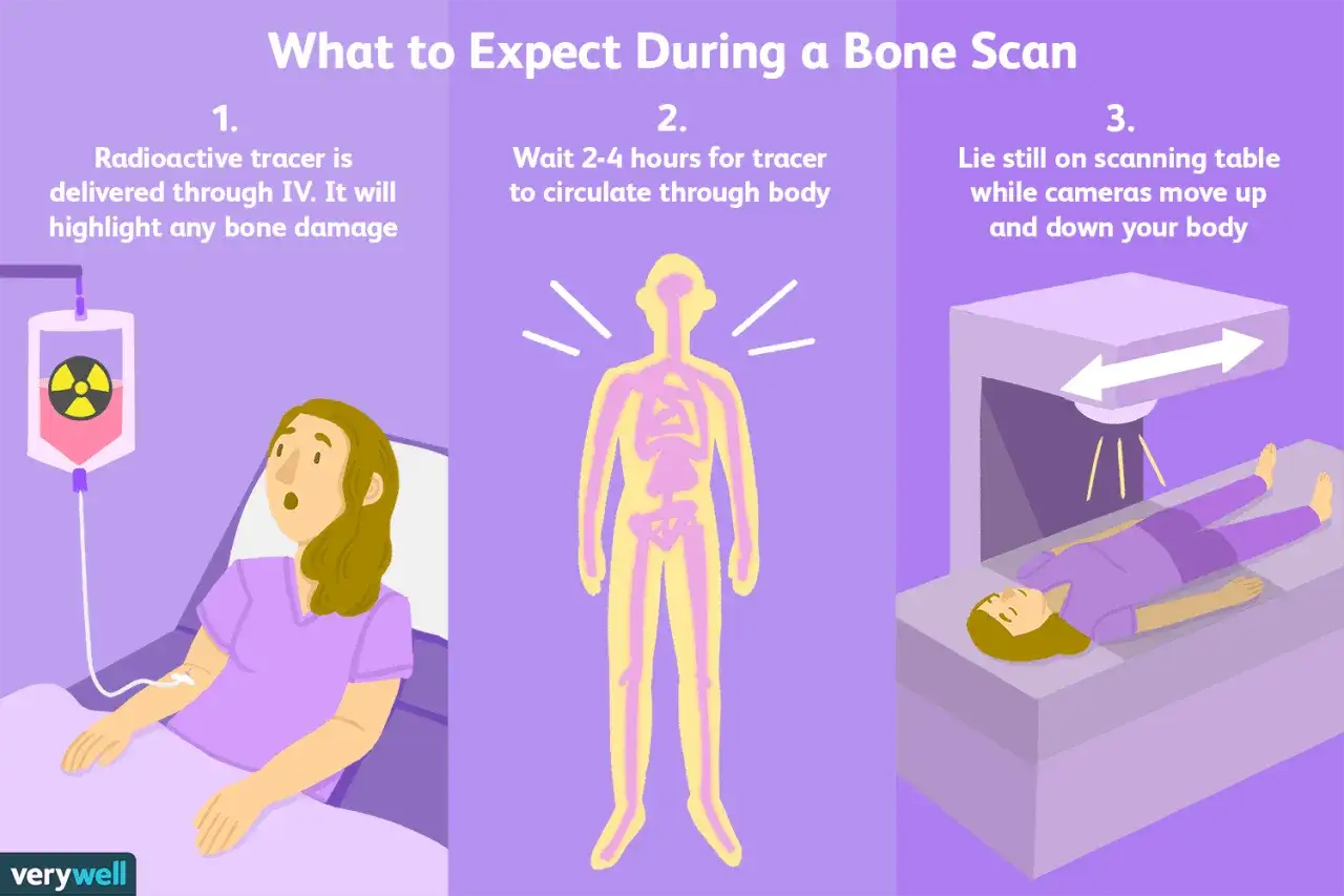 Illustrazione che mostra le fasi di una scintigrafia ossea: iniezione del tracciante radioattivo, attesa della circolazione e scansione del corpo.