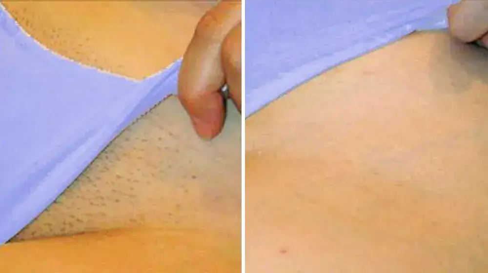 Depilacja laserowa bikini efekty po kilku zabiegach