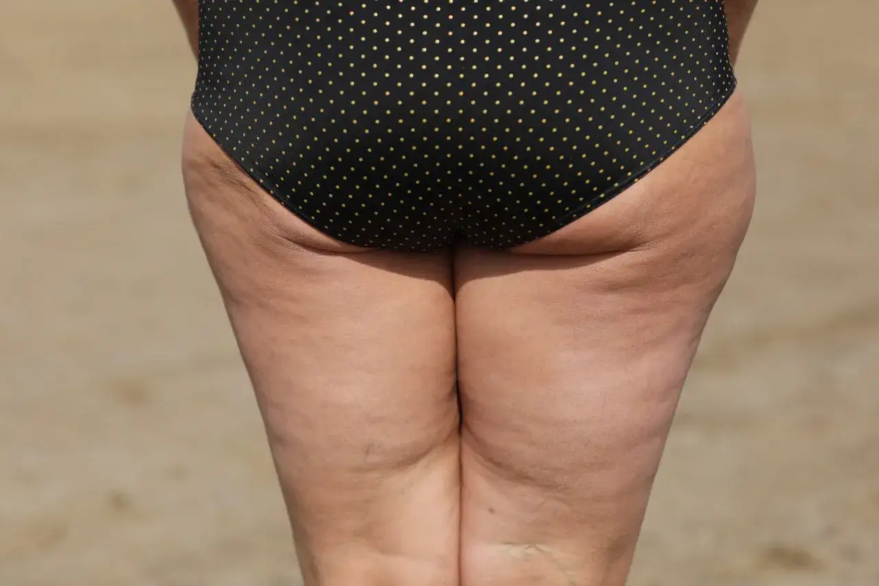 Widoczne nierówności skóry na udach i pośladkach, które mogą być objawem lipodemii.
