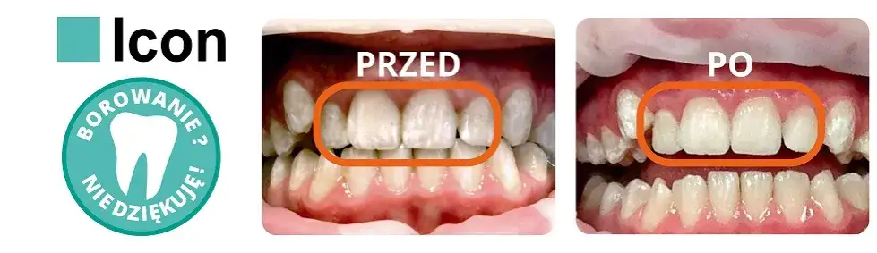 nowoczesne leczenie próchnicy bez borowania ICON ozonoterapia