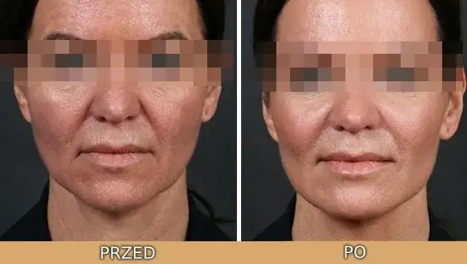 kwas glikolowy przed i po, różne typy cery
