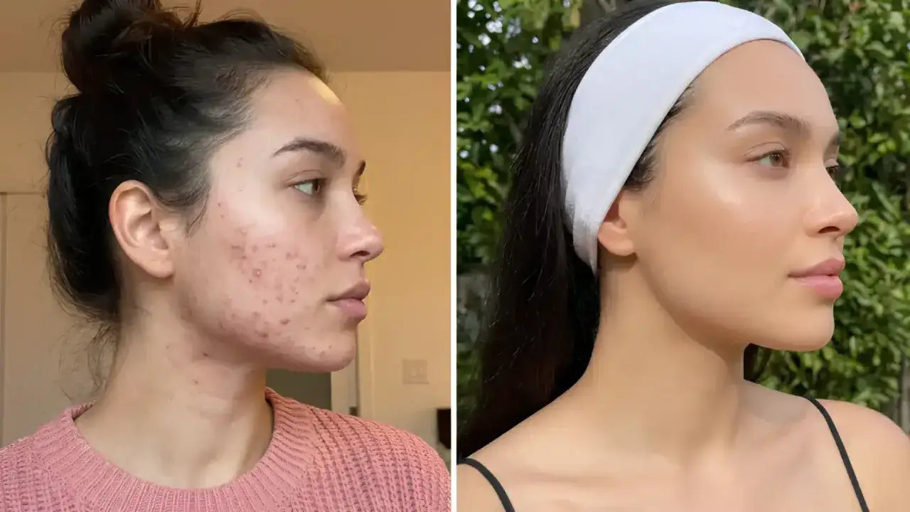 Prima e dopo: la pelle con imperfezioni della pelle &egrave; ora liscia e luminosa, grazie a una routine di cura della pelle efficace.