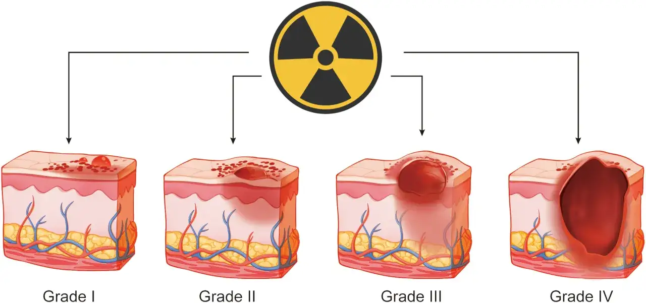 Illustrazione dei danni permanenti da radioterapia: da lesioni lievi (Grado I) a necrosi profonda (Grado IV).