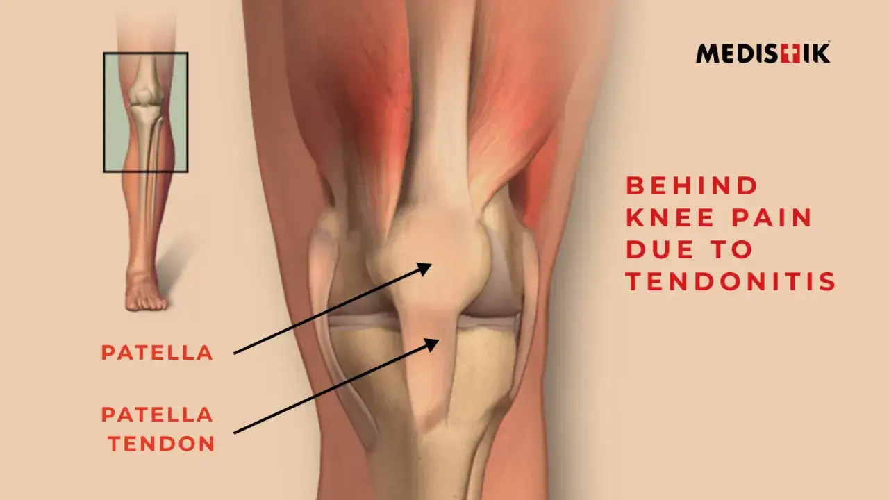 Anatomie du genou, montrant le tendon derrière le genou et la rotule. Douleur derrière le genou due à une tendinite.