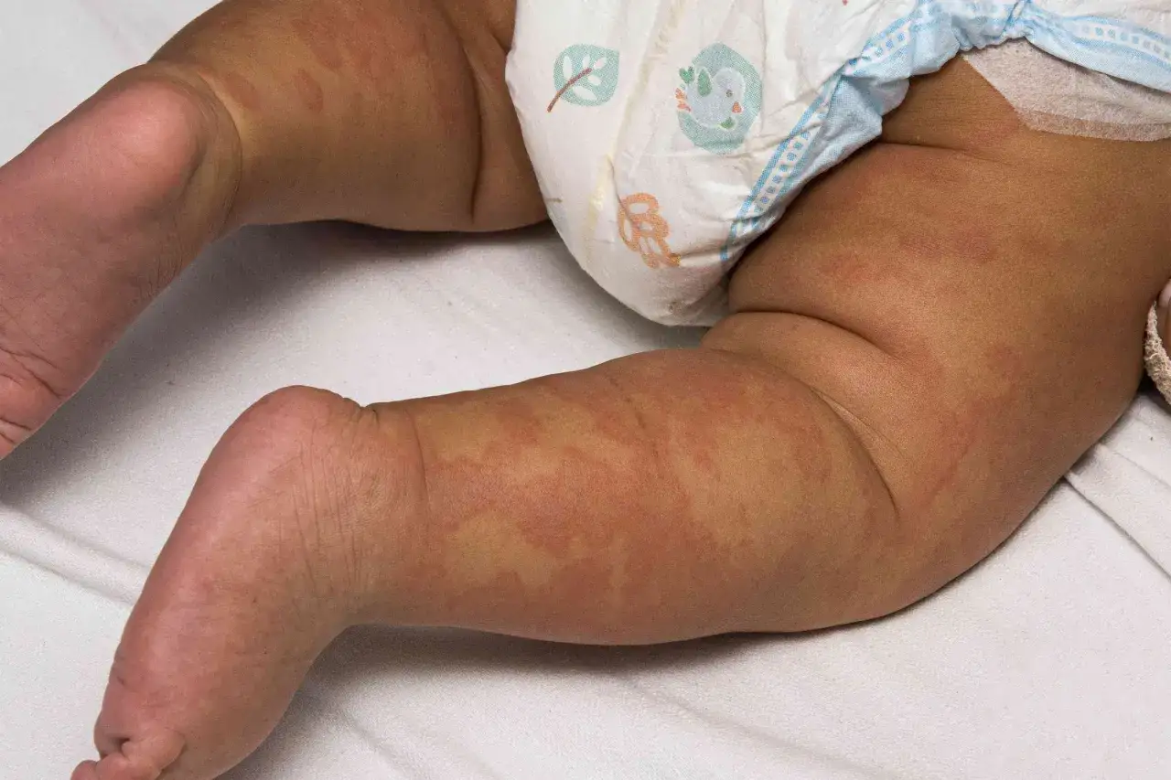 Eruzione cutanea su gambe e addome di un neonato, possibile reazione allergica. Cosa fare in caso di reazione allergica neonato? Consultare un medico.