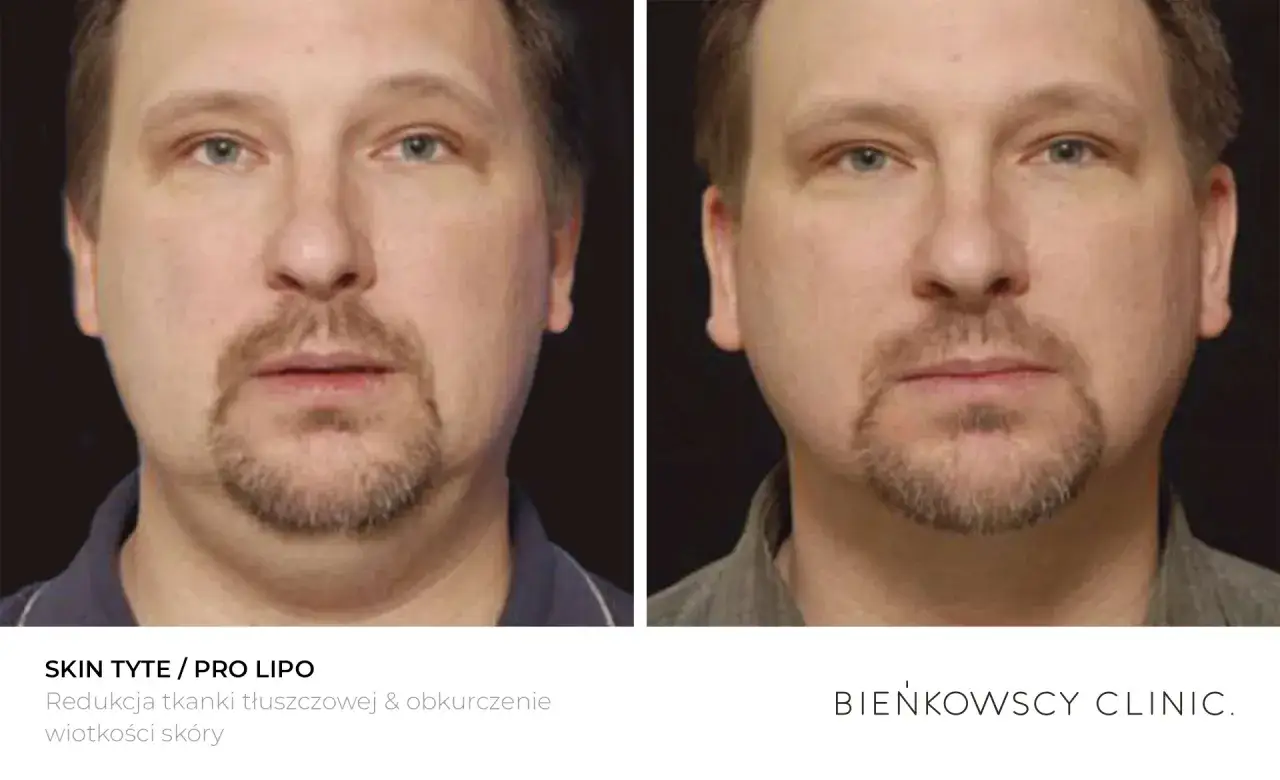Lipoliza iniekcyjna efekty po 1 zabiegu: redukcja tkanki tłuszczowej i obkurczenie skóry podbródka.