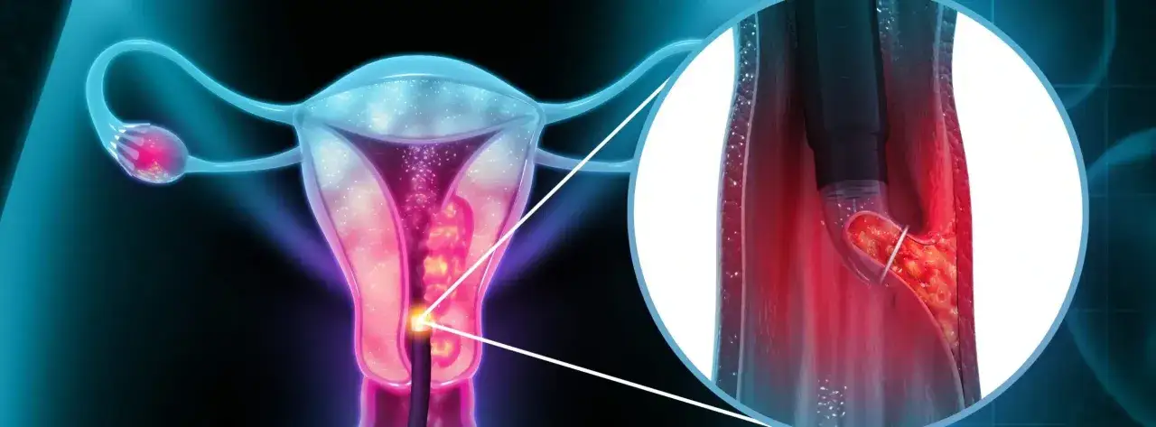 Illustration m&eacute;dicale montrant une endoscopie digestive pour diagnostiquer l'endom&eacute;triose. Un t&eacute;moignage endom&eacute;triose digestive peut &ecirc;tre li&eacute; &agrave; cette image.