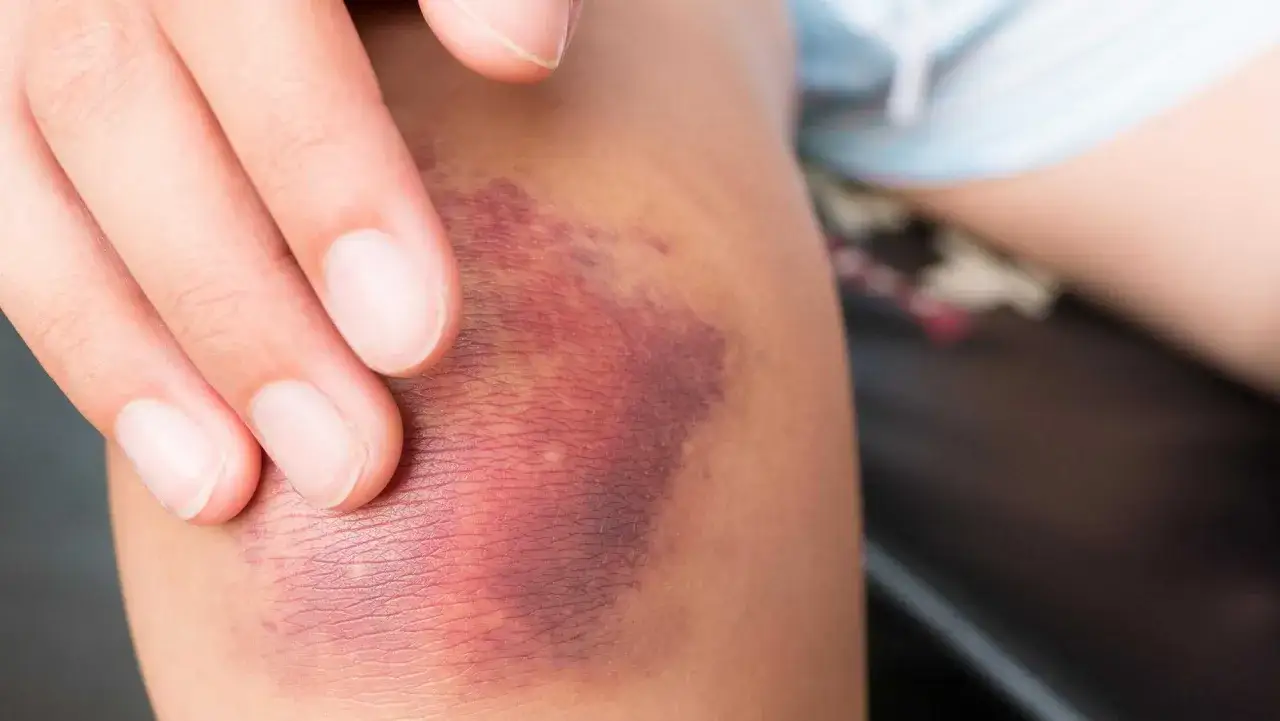 Eine Hand berührt ein Knie mit einer deutlichen Prellung. Die Haut ist rot und blau verfärbt, ein Zeichen für eine Prellung am Knie.