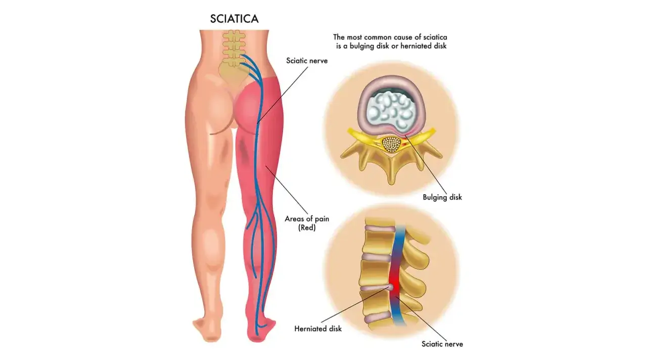 Dolore lungo la gamba dovuto a compressione del nervo sciatico. Illustrazione mostra cause come ernia del disco.