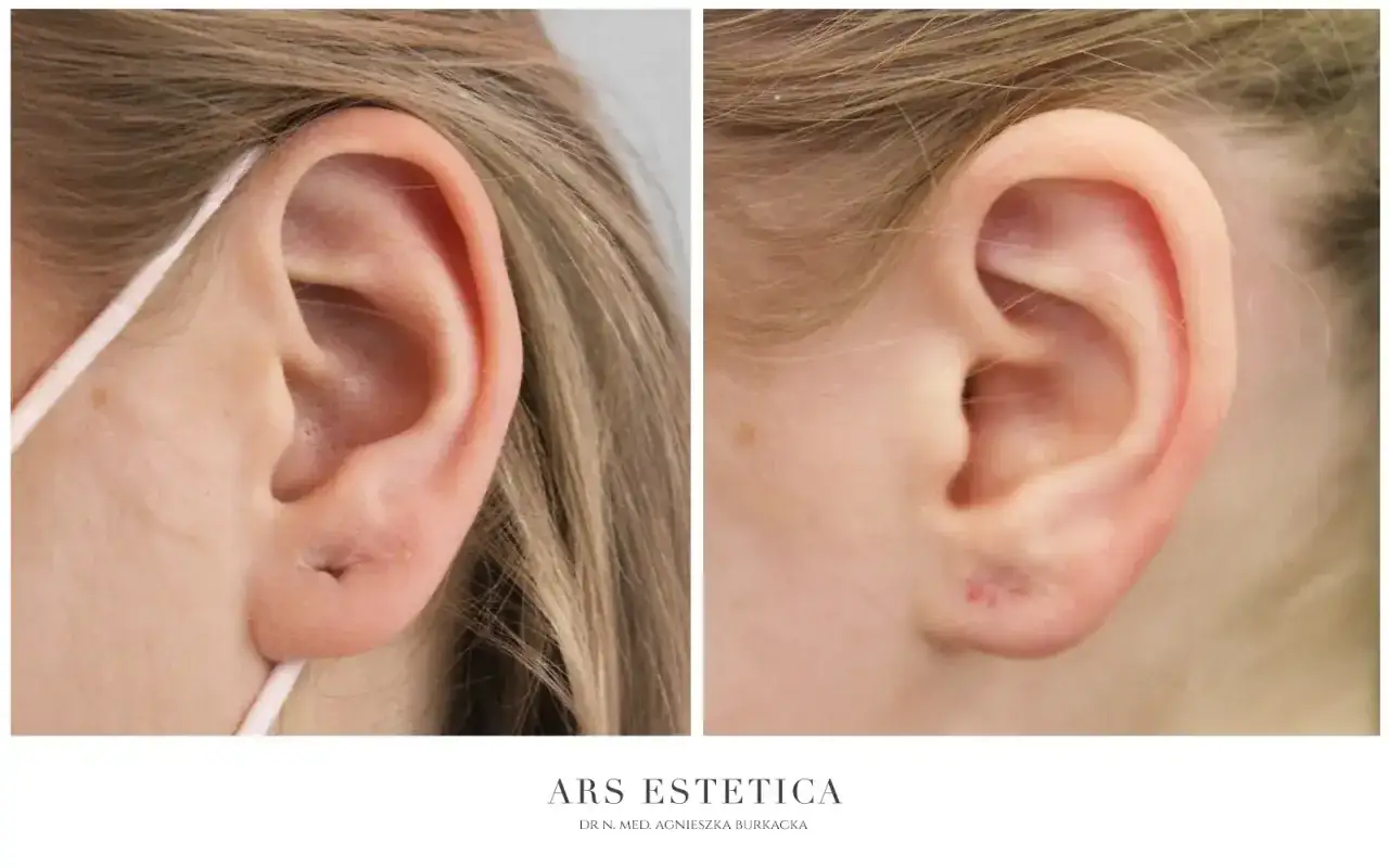 Ucho po zabiegu usunięcia blizny po piercingu upper lobe. Widoczne drobne zaczerwienienie.