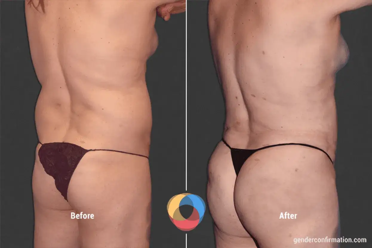 Prima e dopo un intervento di gluteoplastica, che dimostra il bbl significato: un aumento del volume e della forma dei glutei.