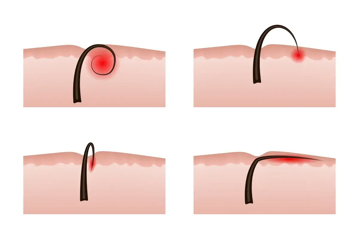Illustrazione di un pelo incarnito e le sue possibili infezioni. Diverse fasi mostrano il pelo che cresce sotto la pelle, causando arrossamento e infiammazione.