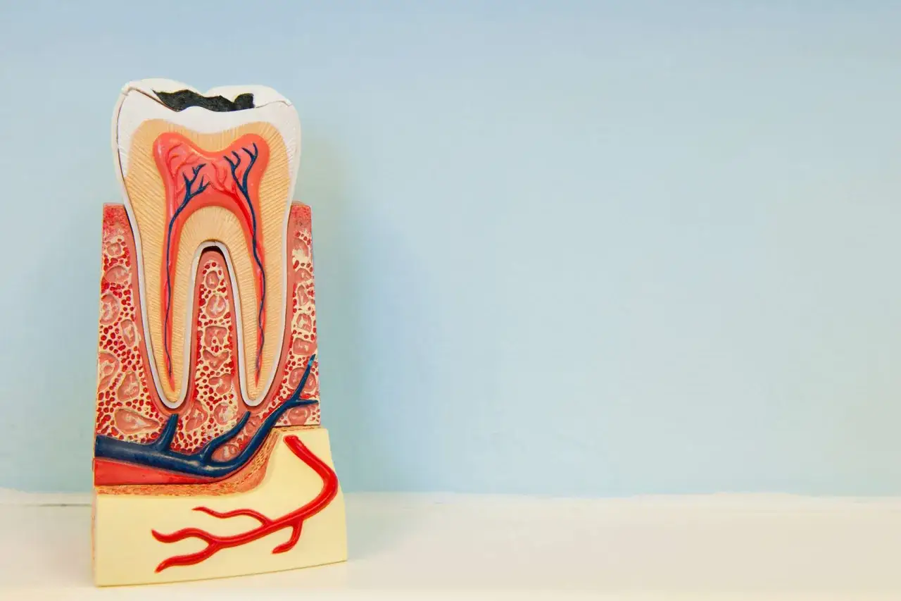 Modelo dental muestra caries profunda que llega a la pulpa dental expuesta, con vasos sangu&iacute;neos y nervios.