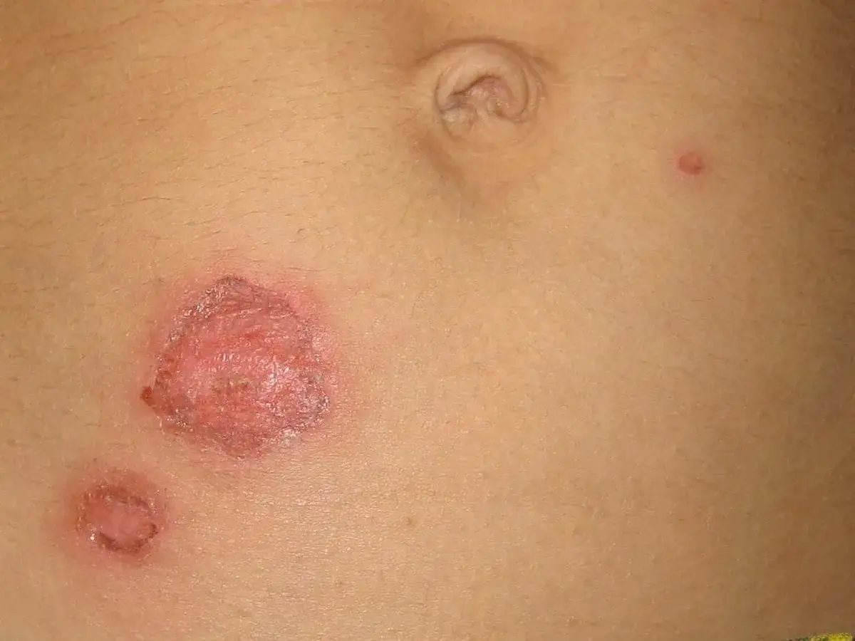 Pelle di bambino con lesioni indicative di impetigine, arrossate e crostose, sull'addome.