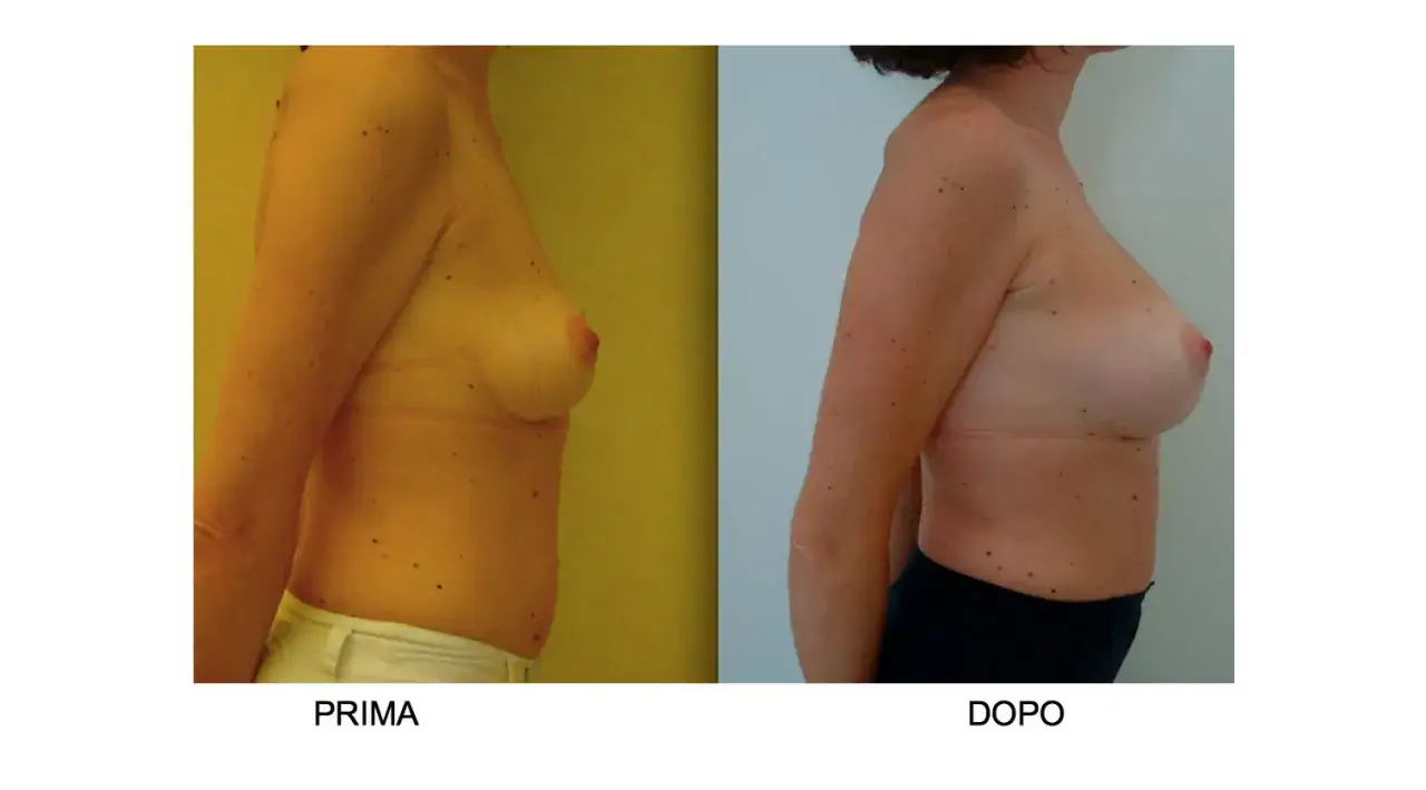 Confronto prima e dopo un intervento di mastoplastica additiva con protesi 400 cc taglia.