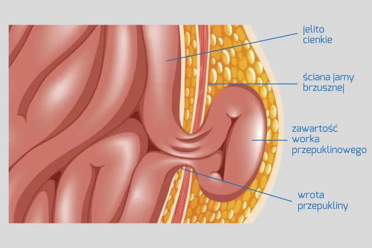 Ilustracja pokazuje przepuklinę pachwinową: jelito cienkie przechodzi przez ścianę jamy brzusznej. Jak długo można chodzić z przepukliną pachwinową?