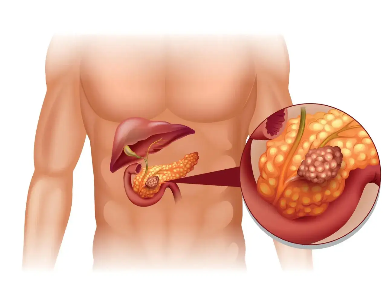 Anatomia człowieka: gdzie jest trzustka? Pokazano jej położenie obok wątroby i dwunastnicy, z powiększeniem uwidaczniającym guzek.