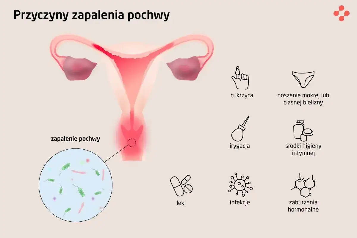 Ilustracja przedstawia budowę narządów rodnych kobiety z zaznaczonym zapaleniem pochwy. Obok ikony symbolizujące przyczyny: cukrzyca, mokra bielizna, irygacja, środki higieny, leki, infekcje, zaburzenia hormonalne.