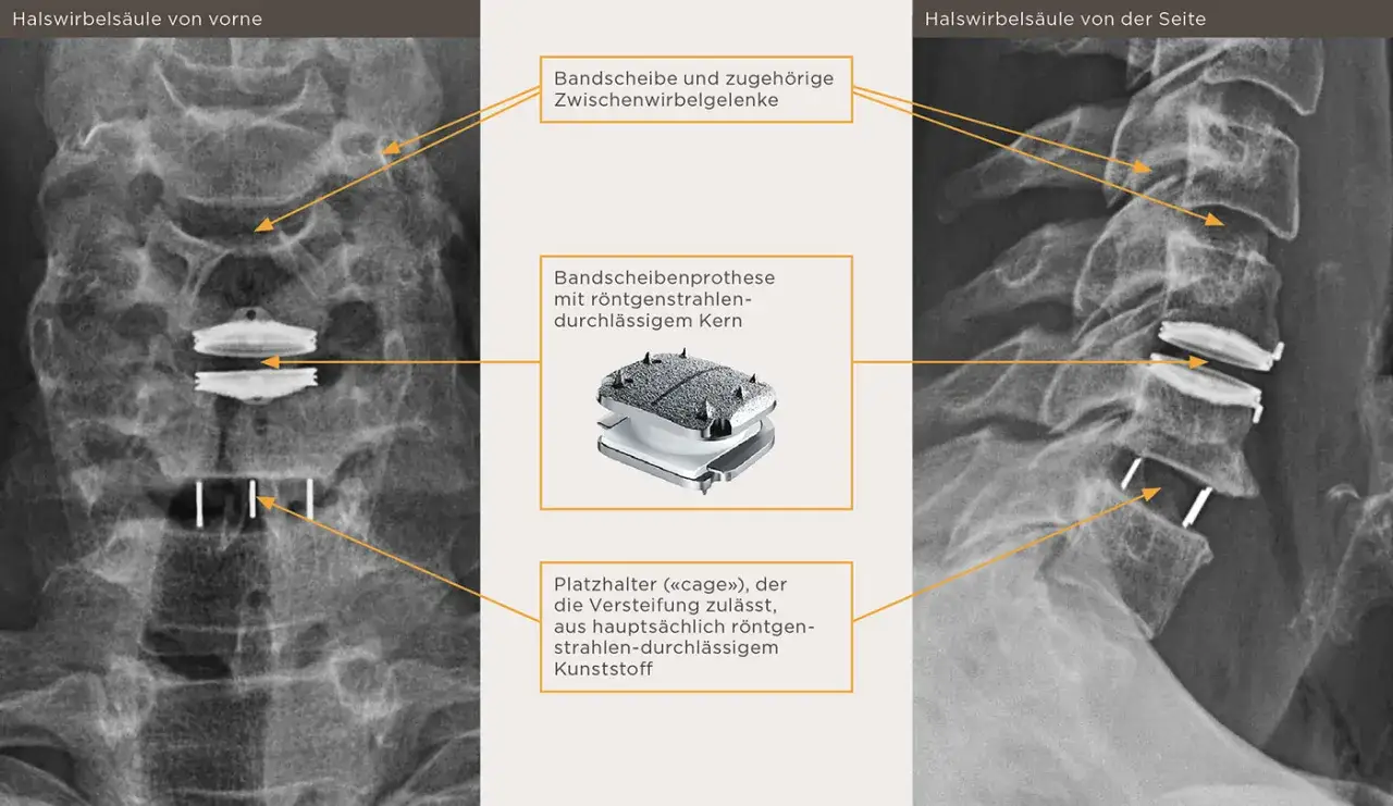 R&ouml;ntgenbilder der Halswirbels&auml;ule zeigen eine Bandscheibenprothese mit einem r&ouml;ntgendurchl&auml;ssigen Kern und einem Platzhalter (