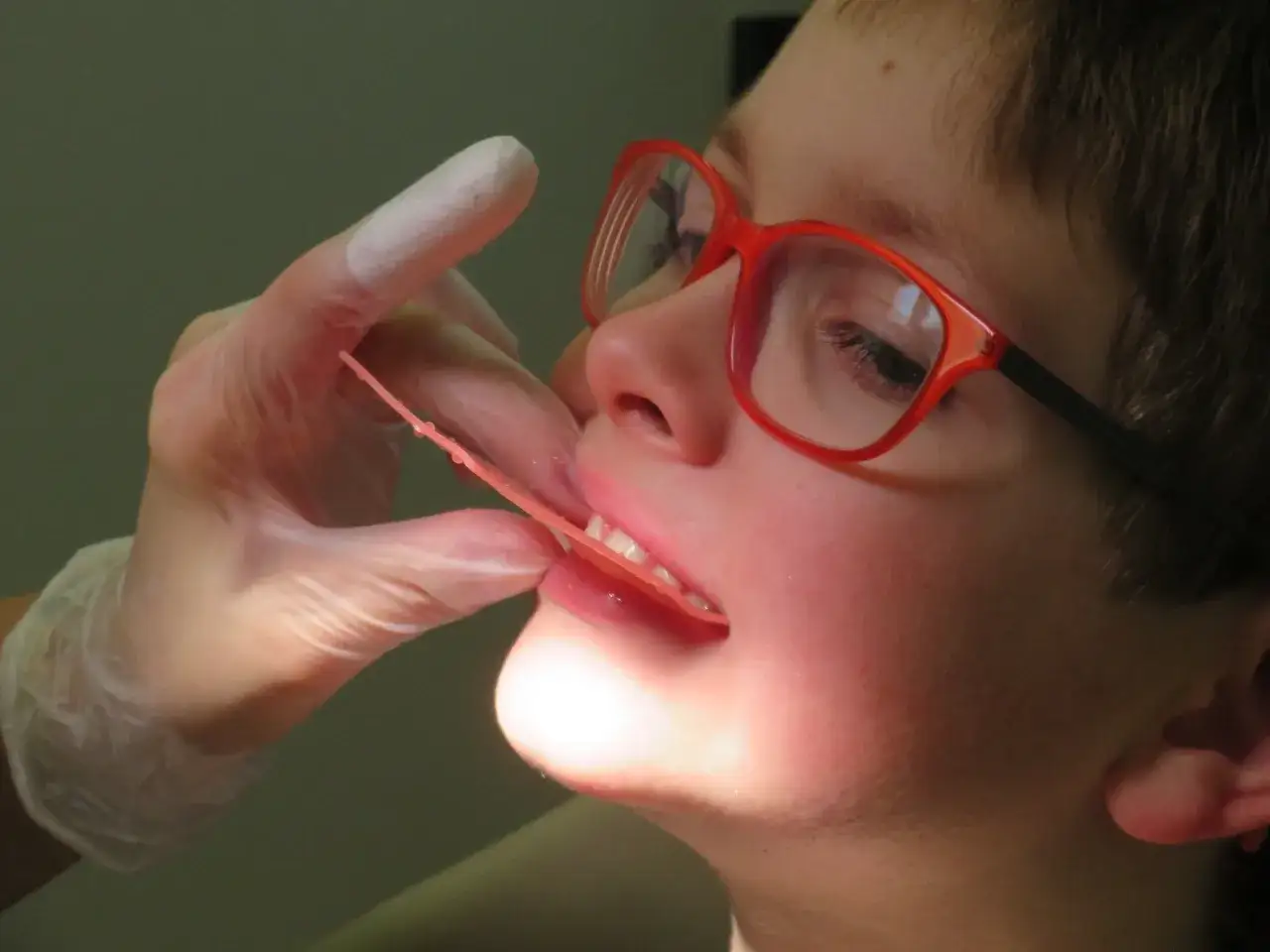 Chłopiec w okularach z czerwonymi oprawkami podczas badania stomatologicznego. Lekarz w rękawiczce bada jego zgryz, być może w celu oceny przodozgryzu rzekomego.
