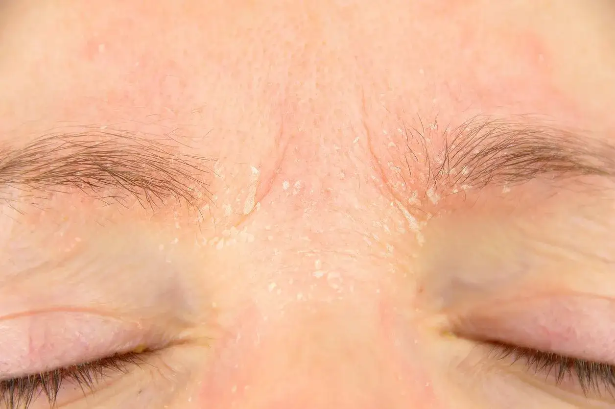 Close-up of a forehead showing red, irritated skin with flaky patches, indicative of a retinol burn.